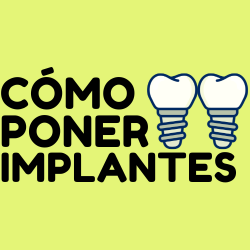 TODO SOBRE LOS IMPLANTES DENTALES
